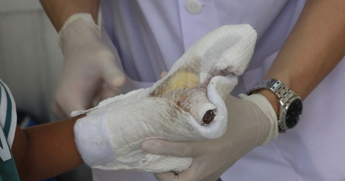 Đã qua Tết gần 2 tháng, nhiều trường hợp vẫn bị bỏng nặng do đốt pháo hoa